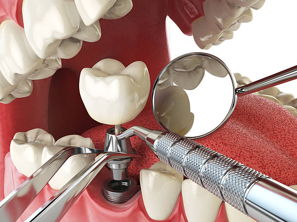 Best Emergency Wisdom Tooth Extraction in Grantsburg, WI